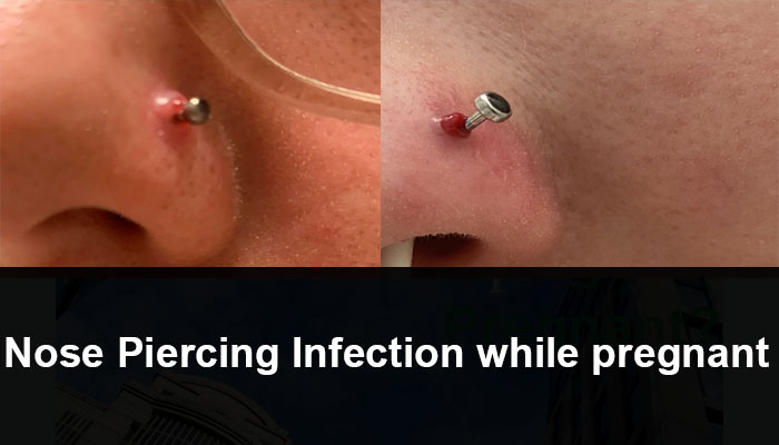 Nose Piercing Infection while pregnant