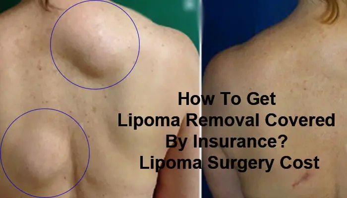 How To Get Lipoma Removal Covered By Insurance? Lipoma Surgery Cost