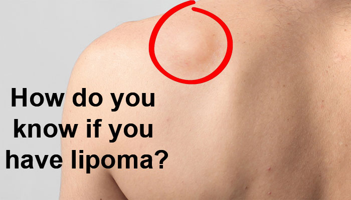 How do you know if you have lipoma?