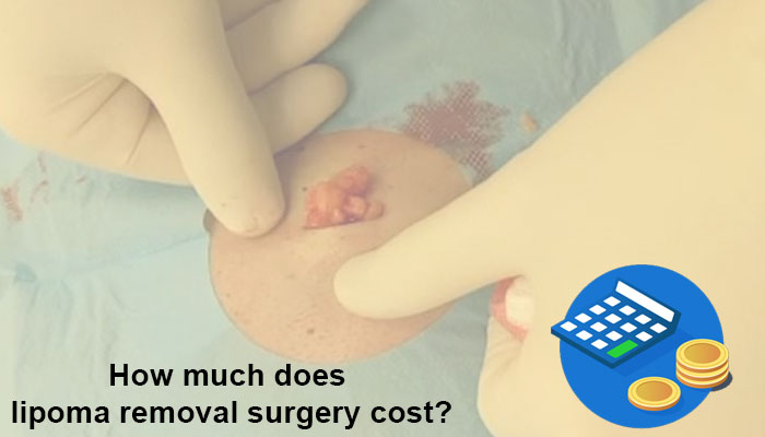 How much does lipoma removal surgery cost?