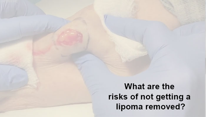 What are the risks of not getting a lipoma removed?