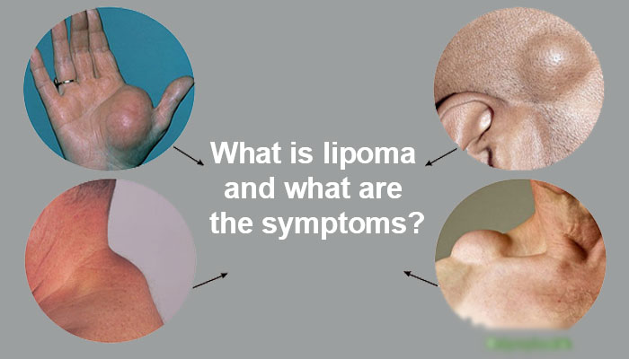 What is lipoma and what are the symptoms?